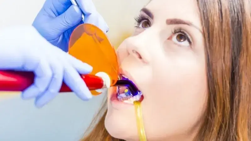 Dental bonding procedure showing resin application to patient's tooth for cosmetic restoration.