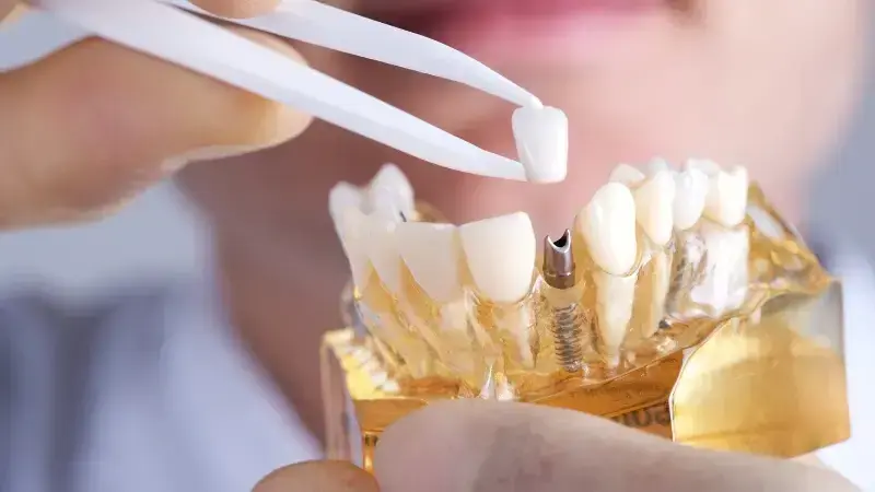 Dental implant model showing tooth replacement options with dental tweezers in Las Vegas.
