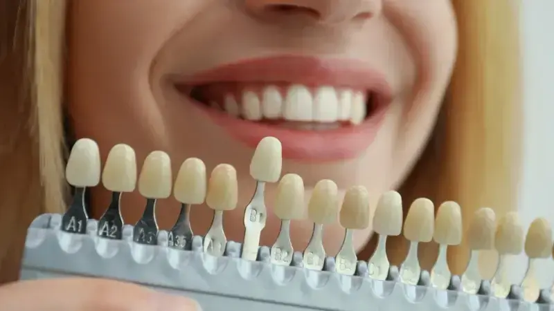 Woman displaying porcelain veneer shade guide showing multiple tooth color options for smile enhancement.