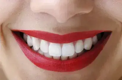 Close-up of a bright white smile with red lipstick on a patient with cosmetic dental work.