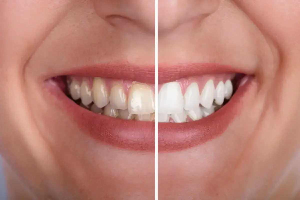 Before and after professional teeth whitening comparison showing whiter, brighter teeth on right side.