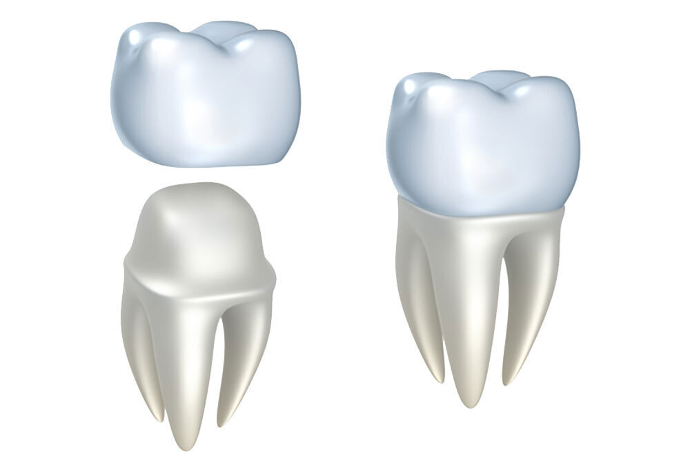 Dental crown illustration showing tooth structure with blue crown restoration on beige root and tooth anatomy.