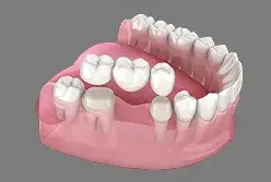 3D dental model showing tooth crowns and bridge restoration on upper and lower teeth.