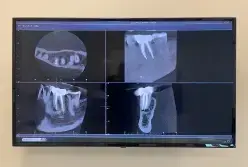 Digital X-ray display showing multiple dental radiographs of teeth and jaw structures.