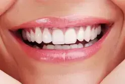 Close-up of a patient's bright white smile showing healthy teeth and pink gums after full-mouth reconstruction.