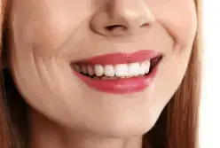 Woman with bright white teeth smiling after professional teeth whitening treatment.