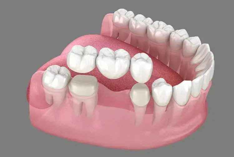 3D dental illustration showing tooth crowns and bridges on implants in Las Vegas.