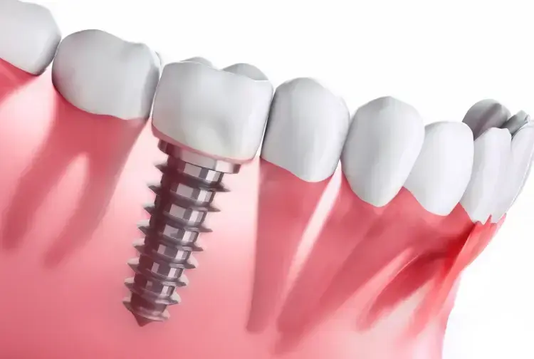 Dental implant illustration showing threaded post in gum with crown restoration.