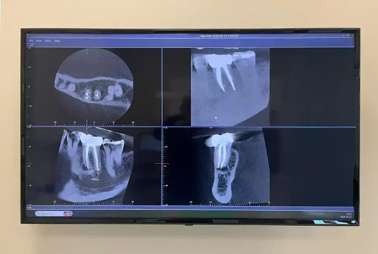 Digital dental X-ray display showing multiple radiographic views of teeth and jawbone structure for diagnostic analysis.