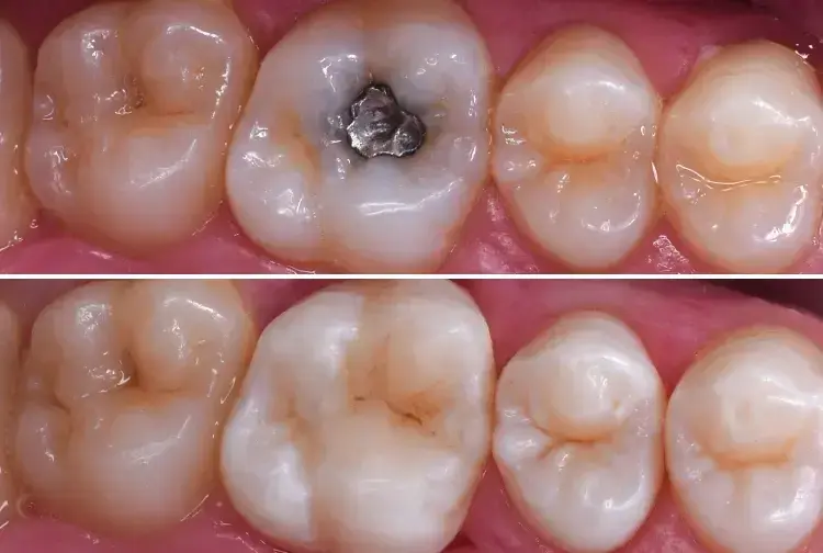 Before and after metal-free dental restorations showing tooth cavity treatment and white filling placement.