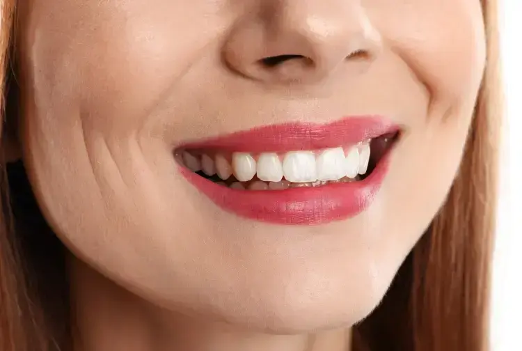 Woman smiling showing bright white teeth after professional teeth whitening treatment.