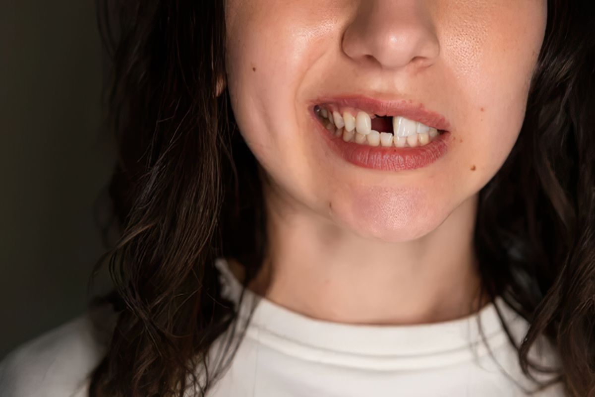 Missing Tooth